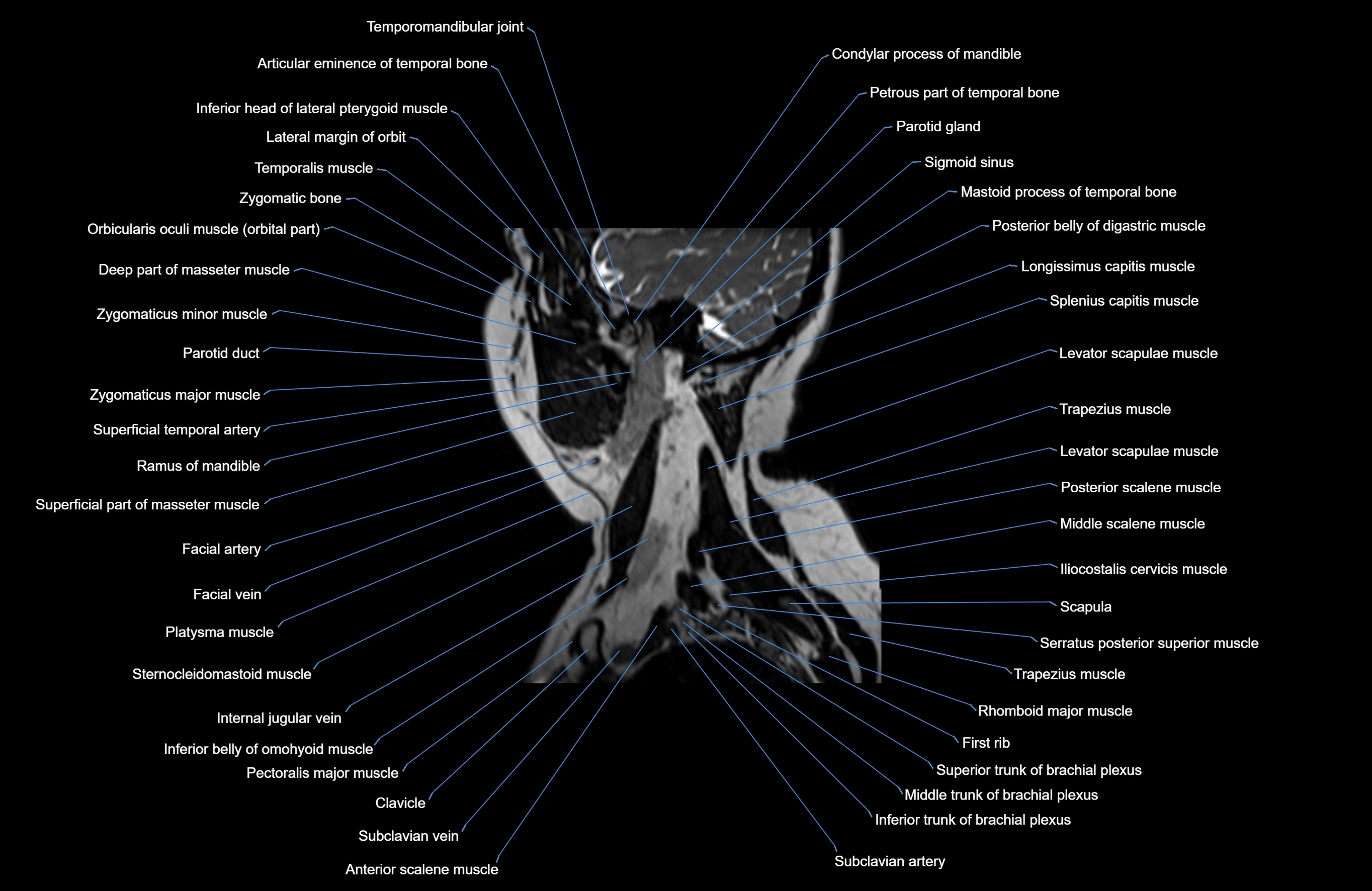 Neck MRI sagittal cross sectional anatomy 3D 1mm 3T radiology  image-img-00001-00029.webp